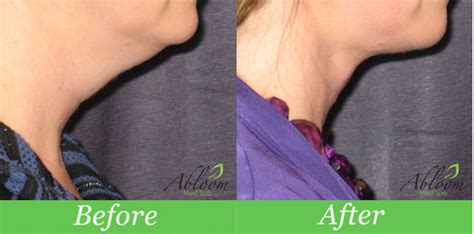 Smartlipo Triplex Neck Before And After Photo By Abloom Med Spa