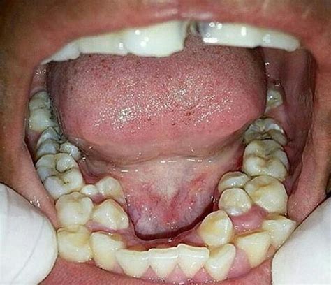 Why Do We Have So Many Teeth Teethwalls