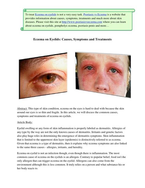 Eyelid Dermatitis Treatments Pictures Photos