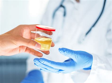 Urine Concentration Test Purpose Procedure And Results