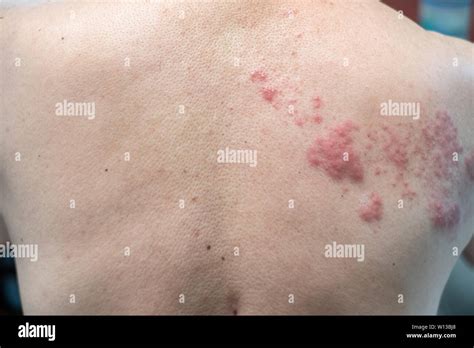 Shingles Blisters Hi Res Stock Photography And Images Alamy