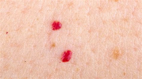 This Is Why You Have Red Marks On Your Skin And When You Should Get