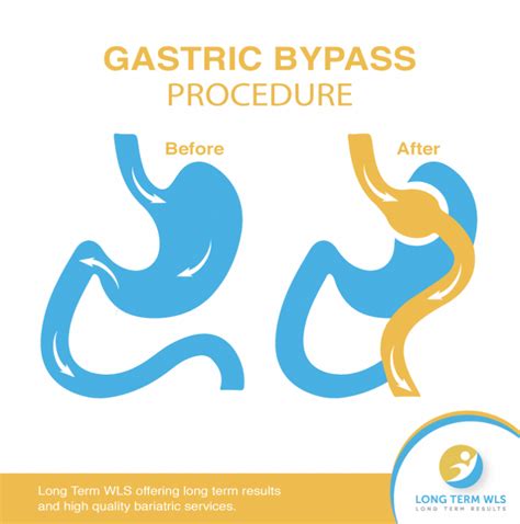 Gastric Sleeve Surgery In Tijuana Mexico Dr Jorge Maytorena