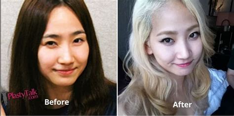 Lilypichu Plastic Surgery Before And After Celebrity Plastic Surgery