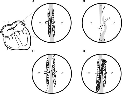 Figure 3 From Percutaneous Closure Of A Complex Intradevice Residual