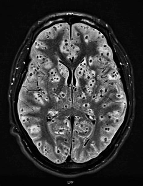 Mri Of The Brain Showing Multiple Ring Shaped Lesions Of Ncc