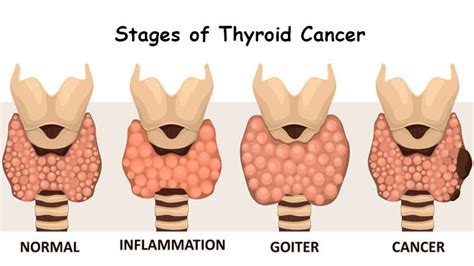 Thyroid Cancer Diagnosis And Treatment From Cancer Specialist In Delhi