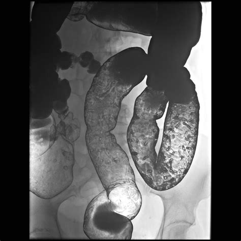 Inflammatory Pseudopolyps Radiology Case Ulcerative