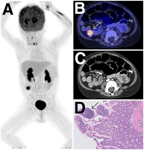 18f Fdg Petct In The Diagnostic And Treatment Evaluation Of Pediatric