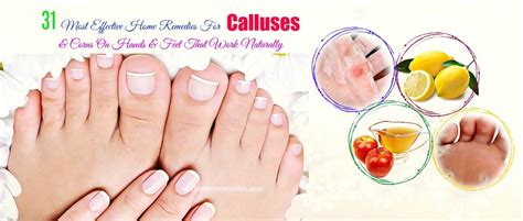 31 Effective Home Remedies For Calluses And Corns On Hands And Feet