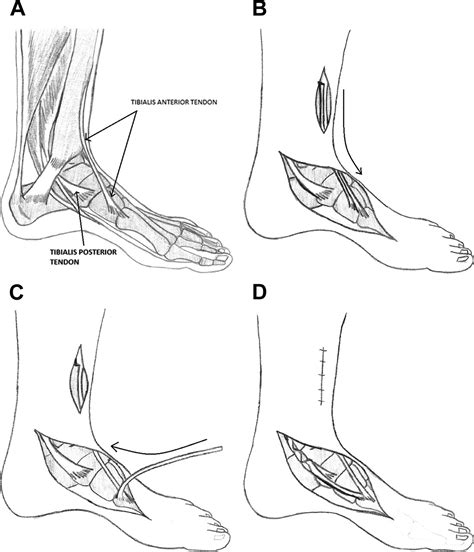 Tibialis Anterior Tendon Transfer For Posterior Tibial Tendon Insufficiency Clinics In