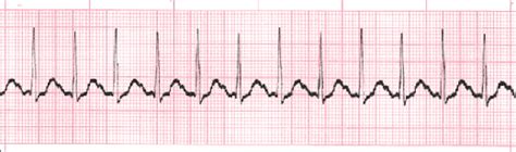 Sinus Rhythms Reference Page EKG Academy