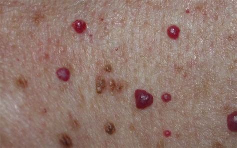 Blood Spots Or Hemangiomas Removal Skin Evolutions Clinic