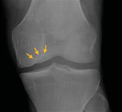 Typical Degenerative Chondral Lesion Of Medial Femoral Condyle Due To