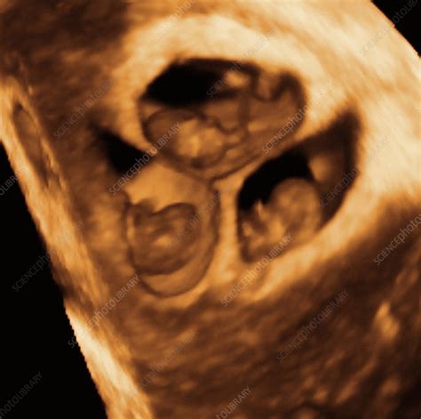 Triplets 3 D Ultrasound Scan Stock Image P6800641 Science Photo