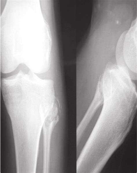 X Ray Right Knee Aplat View Expansile Lytic Lesion Of Fibular Head
