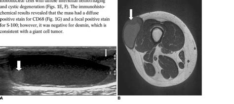 23 Year Old Woman With Giant Cell Tumor Of Soft Tissue In Thigh A