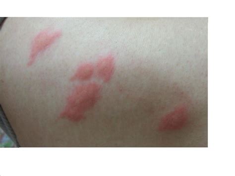 ダニ刺され？？ ( その他の病気 ) - 健康一番 - Yahoo!ブログ