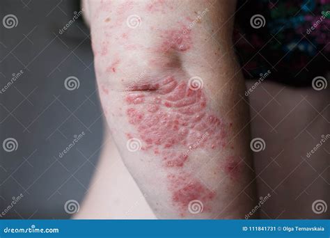 Psoriasis Skin Disease Royalty Free Stock Image