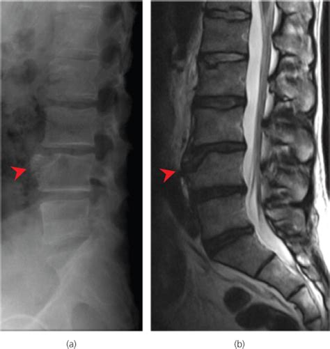 Thoracic And Lumbar Spine Radiology Key