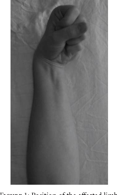 Figure From Chronic Exertional Compartment Syndrome Of The Forearm In