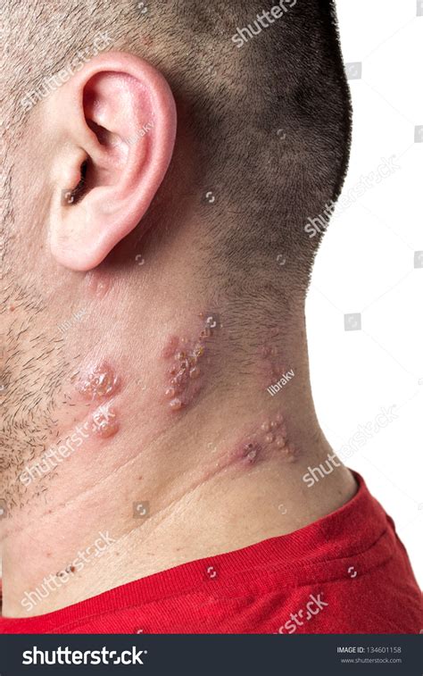 Raised Red Bumps Blisters Caused By Stock Photo 134601158 Shutterstock