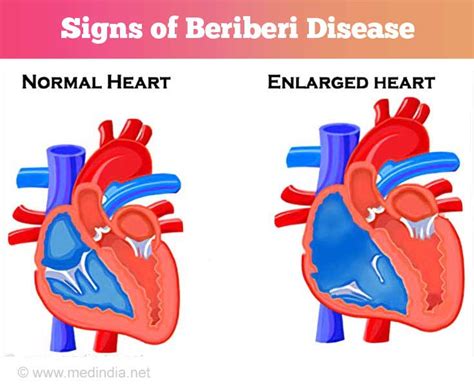 Beriberi Disease Print