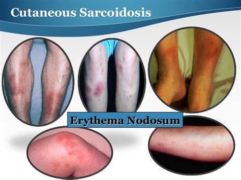 Erythema Nodosum Causes Symptoms And Treatment Health Care Qsota
