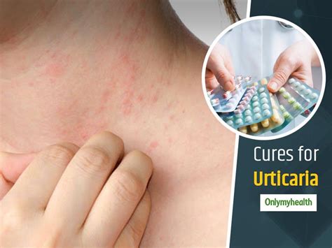 Heres Everything You Need To Know About Urticaria Symptoms Causes And Treatment