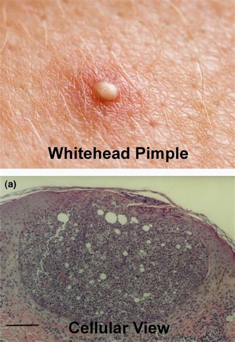 Whitehead Pimple Close Up And Cellular View Pimples Nose Pores