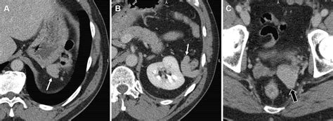 Axial Contrast Enhanced Computed Tomography Images Of The Abdomen A