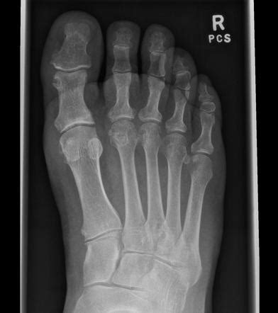 Gout | Image | Radiopaedia.org