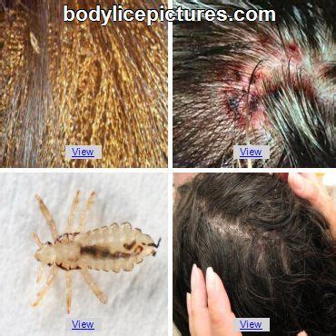 First, draw a hot bath. Removing Fleas From Human Hair - 20 Easy Hairstyles for ...