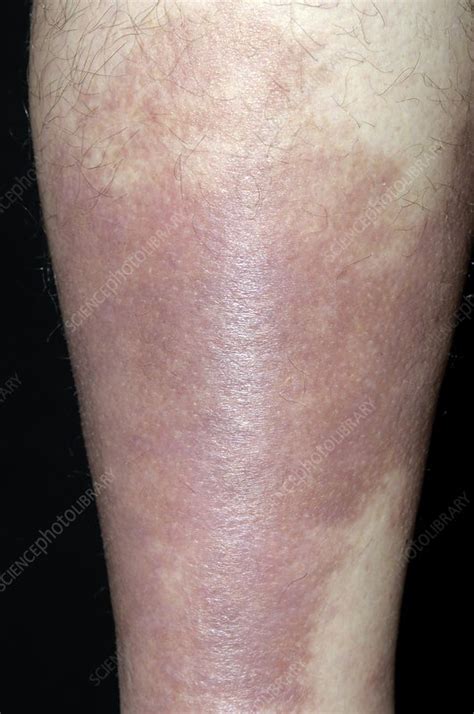 Pigmentation After Cellulitis Of The Leg Stock Image C0042433
