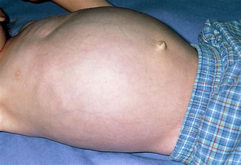 The entire tumor was removed with surgery. Swollen Abdomen Due To Hepatomegaly From Cancer Photograph ...