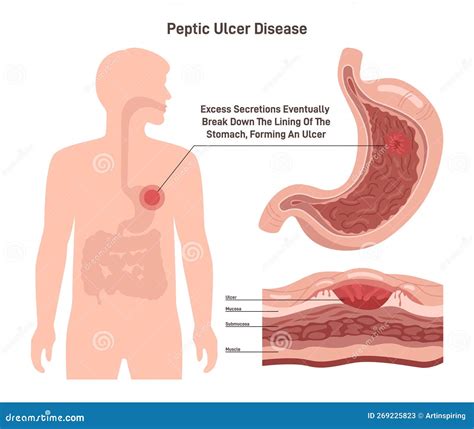 Ulcera Peptica Parete Dello Stomaco Con Ferita Sul Rivestimento
