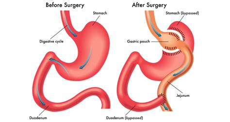Mini Gastric Bypass And Gastric Bypass What Is The Di Vrogue Co
