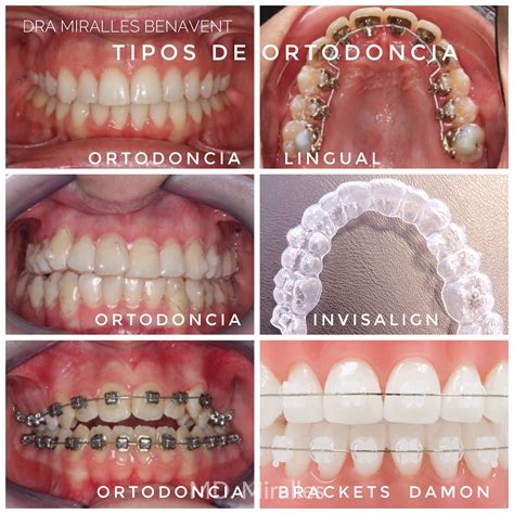 Tipos De Ortodoncia ClÍnica Dental Doctora Miralles