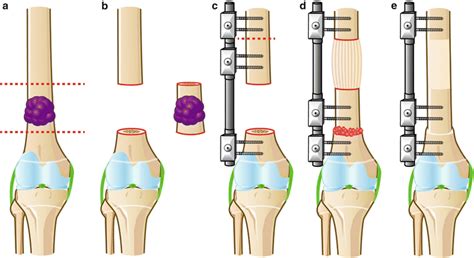 Management Of Juxtaphyseal Malignant Bone Tumors Around The Knee Joint