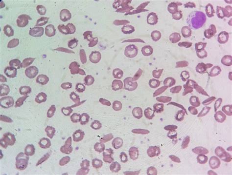 Anemia Falciforme1 Lab Prática