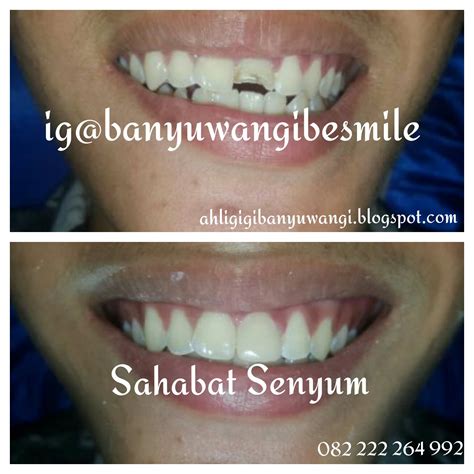 Sambung Gigi Patah Dengan Komposite / Laser By Ahli Gigi Banyuwangi