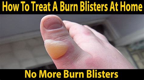 Foot Blister Remedies Foot Care Tips