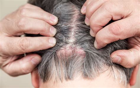 Scalp Psoriasis Diagnosis And Treatments Wimpole Clinic