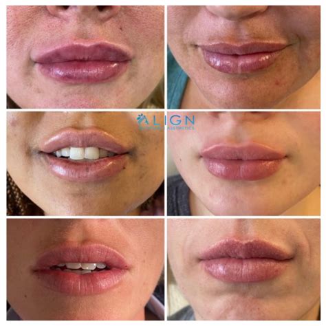 Faq Lip Injections Align Injectable Aesthetics