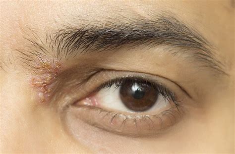 Shingles In The Eye Ocular Shingles Symptoms And Treatments