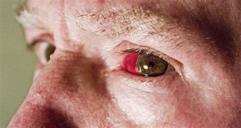 Why Do Blood Vessels Burst In Eyes