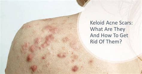 Keloid Acne Scars What Are They And How To Get Rid Of Them Dream
