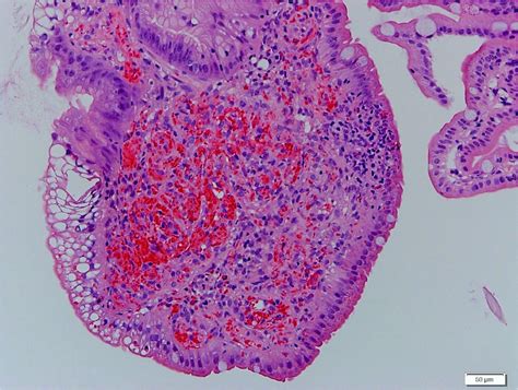 Pathology Outlines Portal Hypertensive Gastropathy