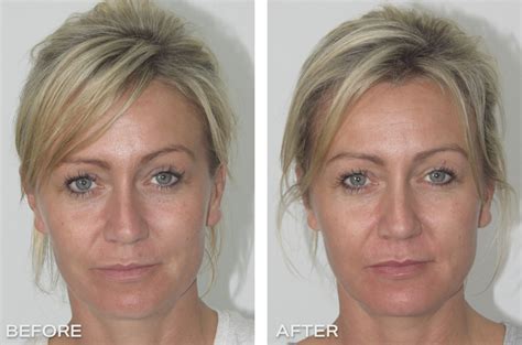 Before After Thread Lift Procedures Thread Lift Docto