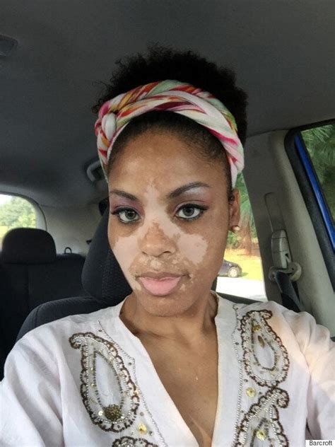 From middle english face, from old french face, from vulgar latin *facia, from latin faciēs (form, appearance), from facere (to make, do). Mum With Vitiligo Embraces Rare Skin Condition: 'I'm Still ...
